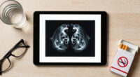 Years After He Quit Smoking, A Lung Cancer Scan Saved His Life