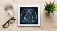 Years After He Quit Smoking, a Lung Cancer Scan Saved His Life